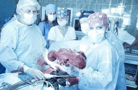 У Львівській клінічній лікарні швидкої медичної допомоги видалили пухлину вагою 10 кілограм